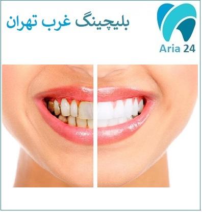 بلیچینگ دندان غرب تهران کلینیک تخصصی Dental Castle